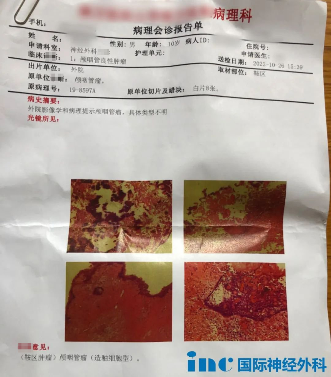 顱咽管瘤復(fù)發(fā)？需要手術(shù)嗎？