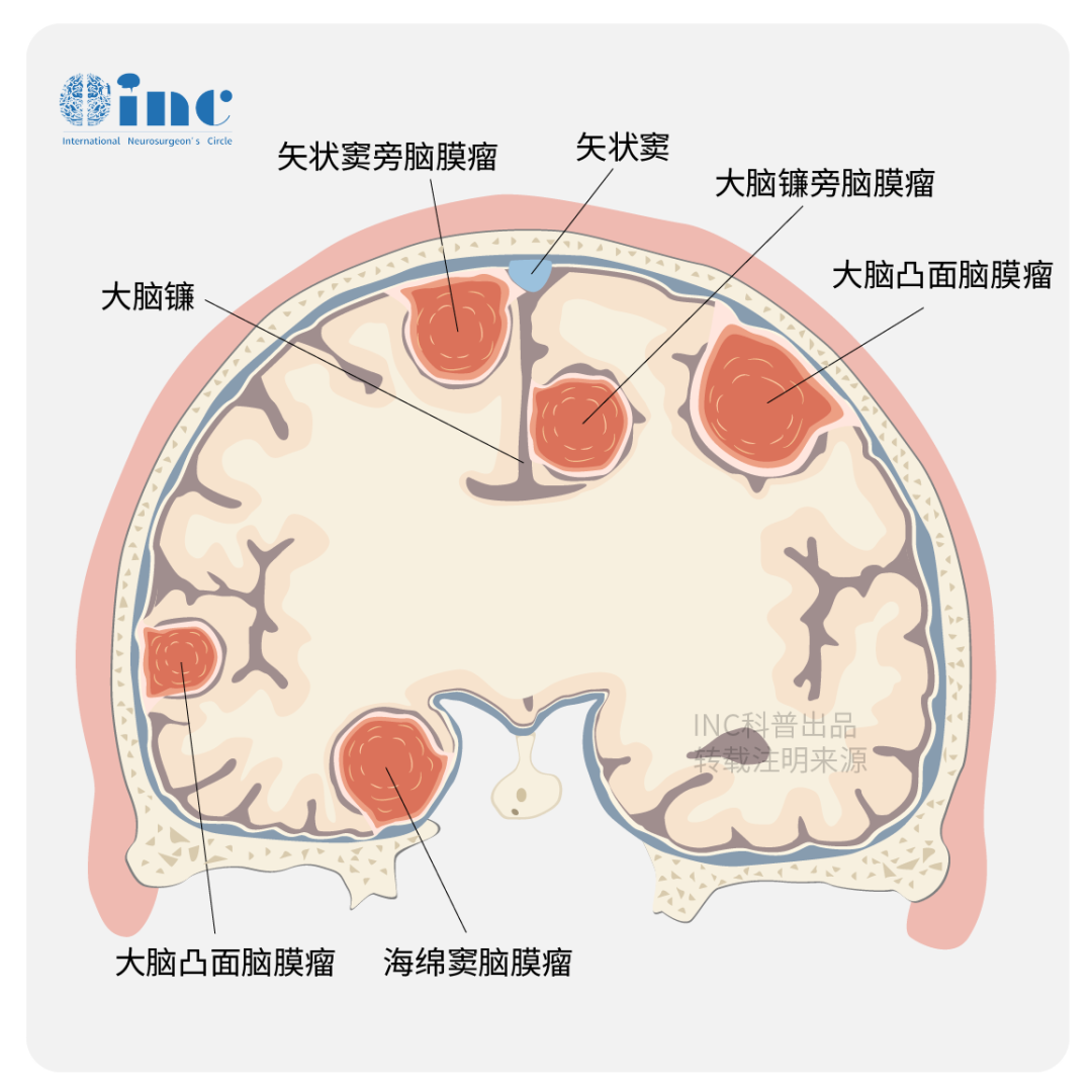 疑難位置腦膜瘤