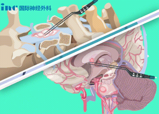 雙較電凝是什么？