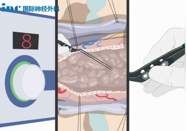 雙較電凝是什么？