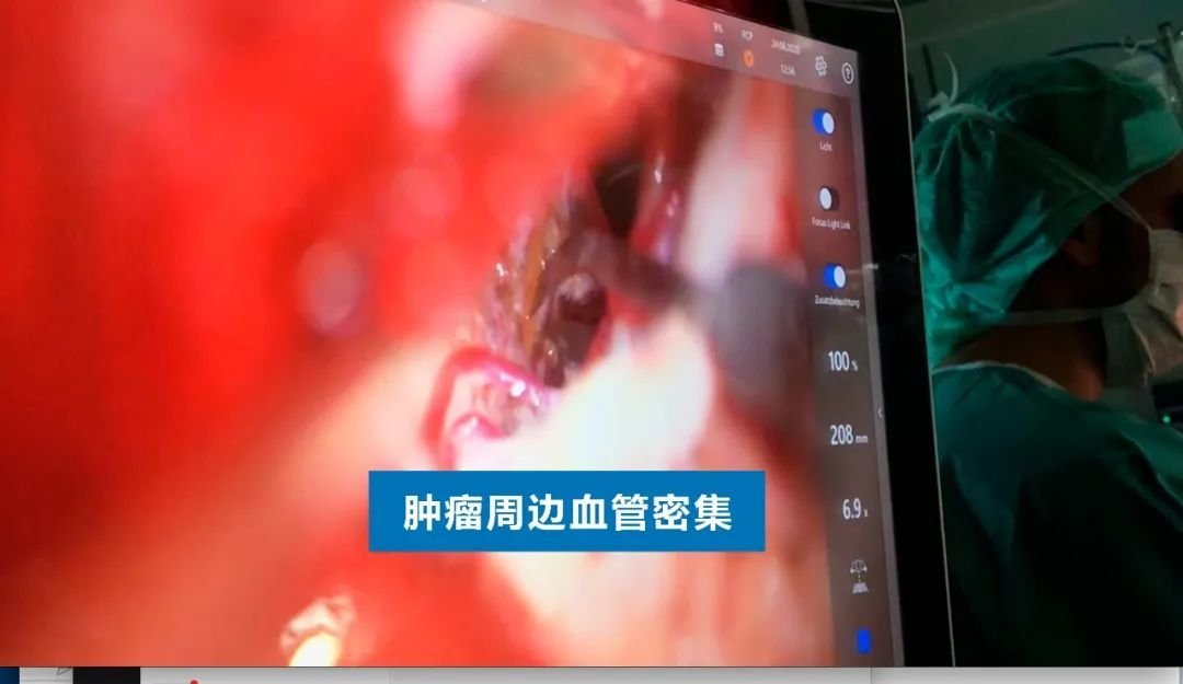 INC德國巴特朗菲教授手術(shù)實(shí)拍