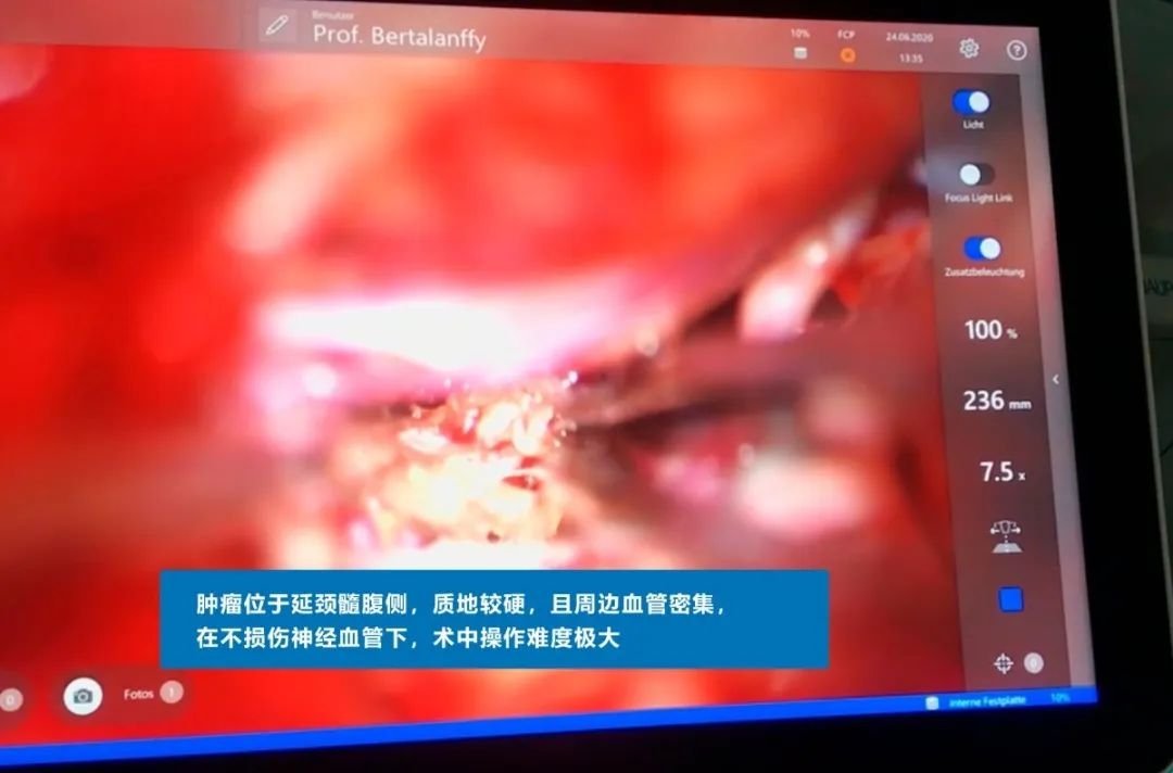 INC德國巴特朗菲教授手術(shù)實(shí)拍