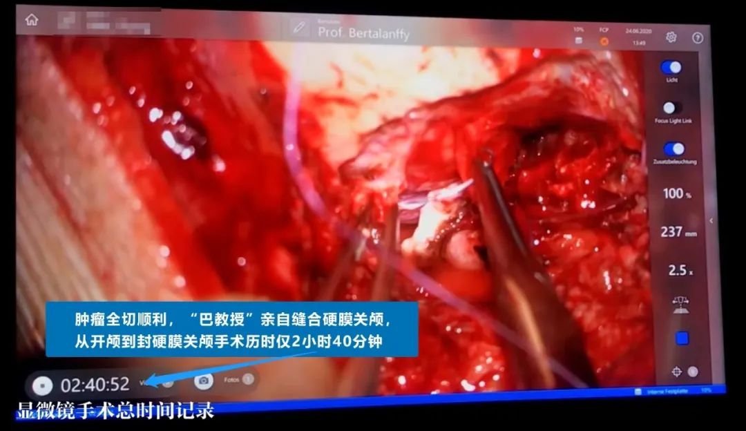 INC德國巴特朗菲教授手術(shù)實(shí)拍