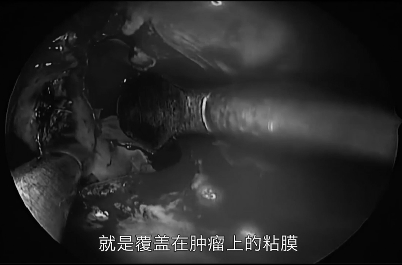 在突起的粘膜上開了個口，就是覆蓋在腫瘤上的粘膜
