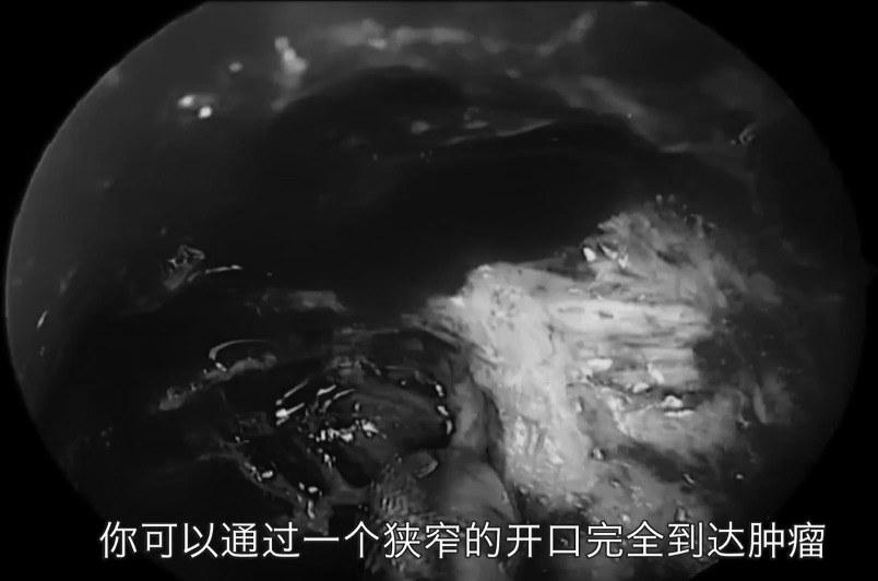 可以通過一個狹窄的開口完全到達(dá)腫瘤