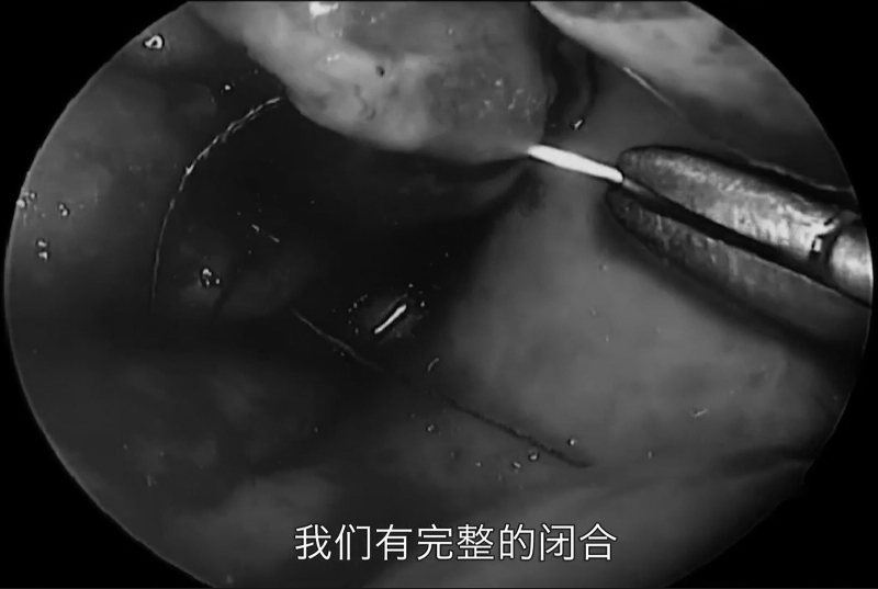 現(xiàn)在進(jìn)行縫合，然后，縫合之前黏膜上的切口，達(dá)到完整的閉合。
