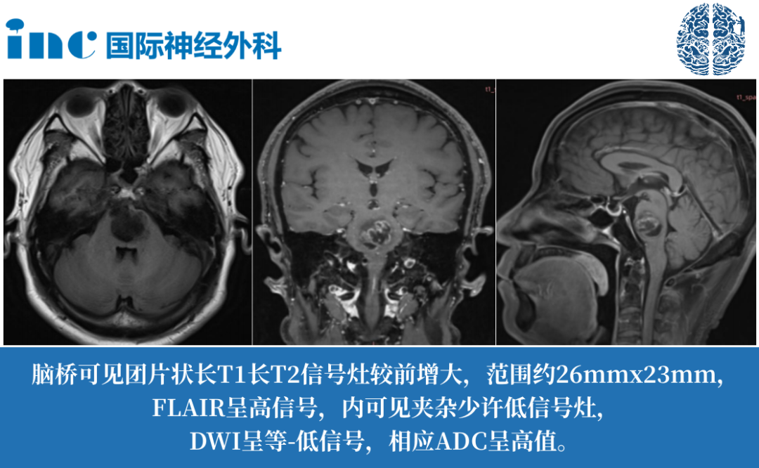 57歲男性-腦干膠質(zhì)瘤