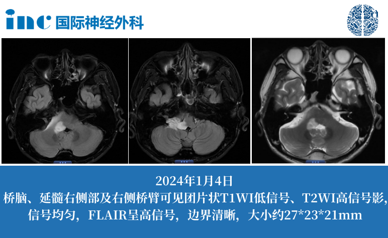36歲男性-橋腦、延髓右側(cè)及右側(cè)橋臂占位