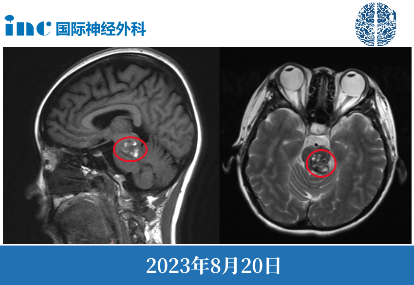 治療腦干海綿狀血管瘤