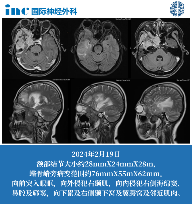 蝶骨嵴旁腦膜瘤復發(fā)