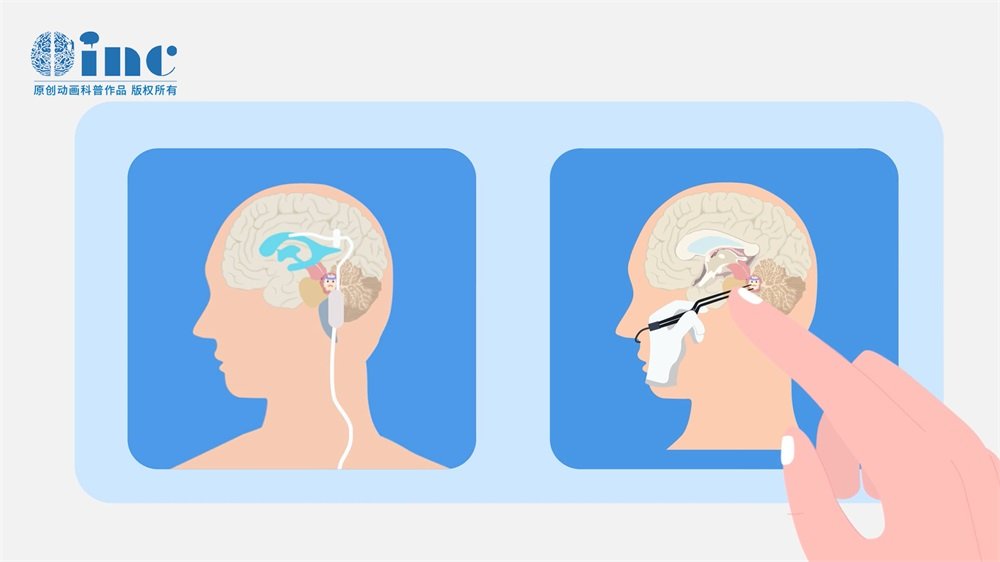 腦橋膠質瘤能全切嗎？能活多久？