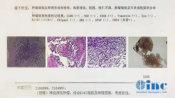 劉先生的術(shù)后病理結(jié)果為良性，無需其他治療