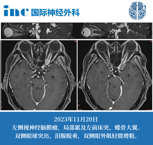 57歲女性-左側(cè)視神經(jīng)腦膜瘤（術(shù)后）  　　從沒(méi)想過(guò)腦腫瘤也會(huì)導(dǎo)致視力下降