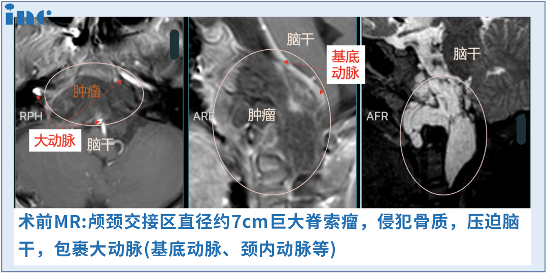 6歲男孩-較大脊索瘤壓迫腦干  　　4年內(nèi)3次手術(shù)，多次復(fù)發(fā)，從未放棄生存希望