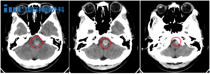 28歲高難度腦干延髓海綿狀血管瘤真實案例CT
