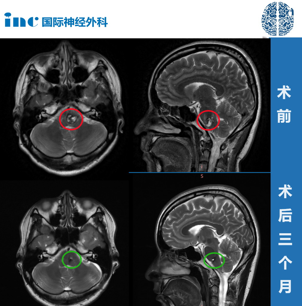 28歲高難度腦干延髓海綿狀血管瘤真實案例