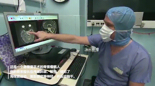 復(fù)雜脊索瘤長(zhǎng)在斜坡、鞍區(qū)、侵犯海綿竇  　　不開(kāi)顱如何順利手術(shù)？