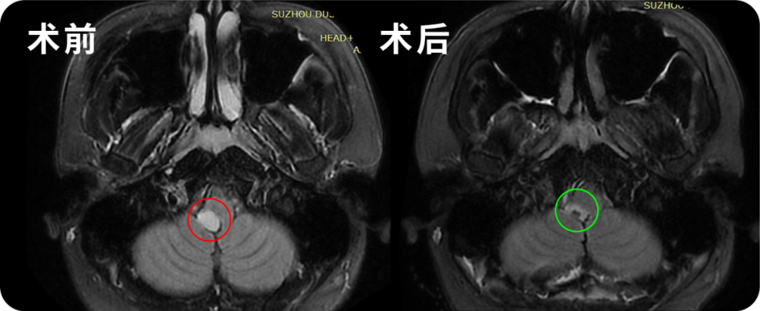 24歲男性-腦干延髓低級(jí)別膠質(zhì)瘤