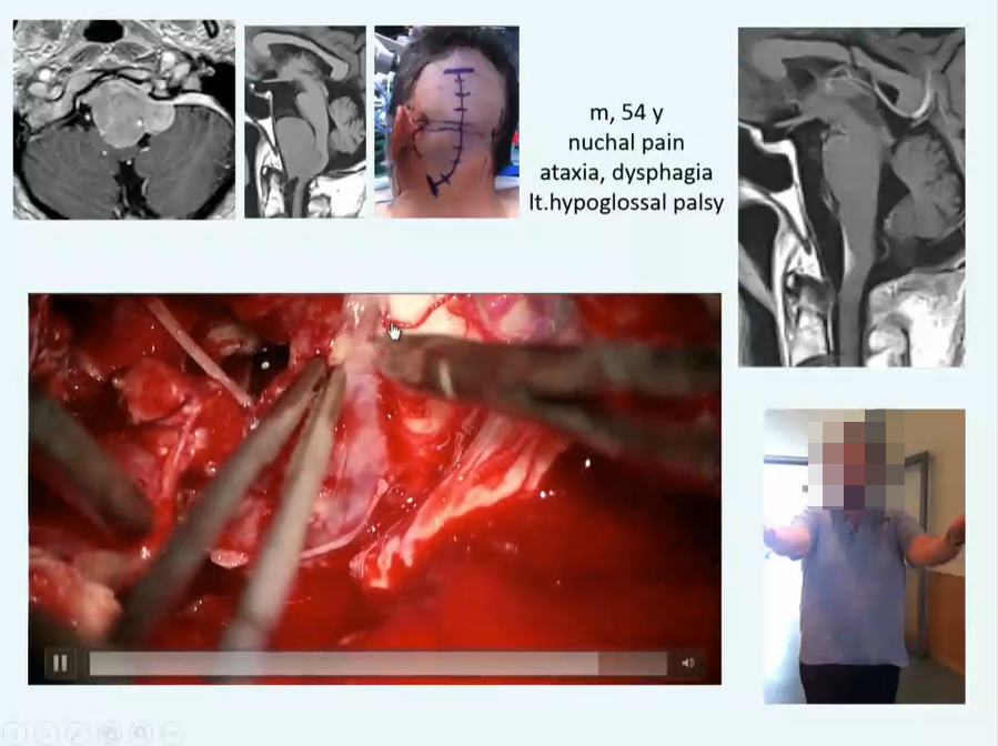 枕骨大孔區(qū)腦膜瘤成功真實案例圖片5