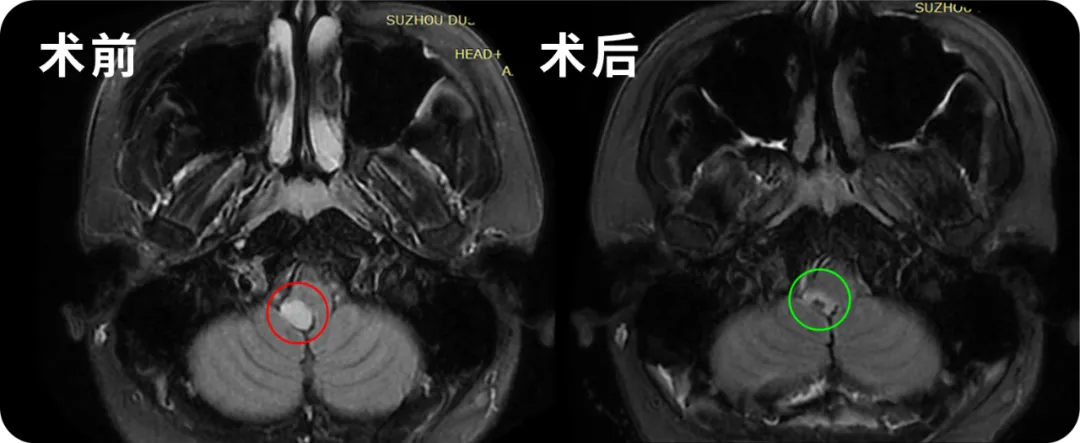 腦干延髓膠質(zhì)瘤影像圖片