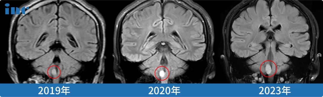 腦干延髓膠質(zhì)瘤真實(shí)案例影像圖片