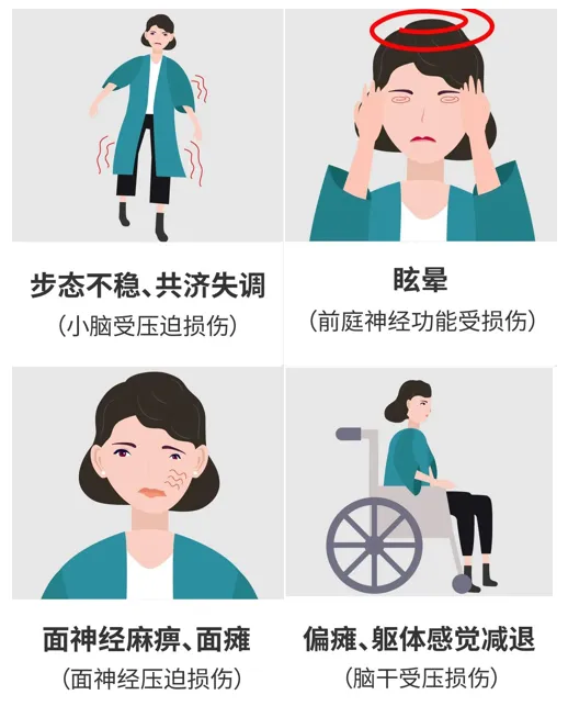橋臂膠質(zhì)瘤癥狀圖片