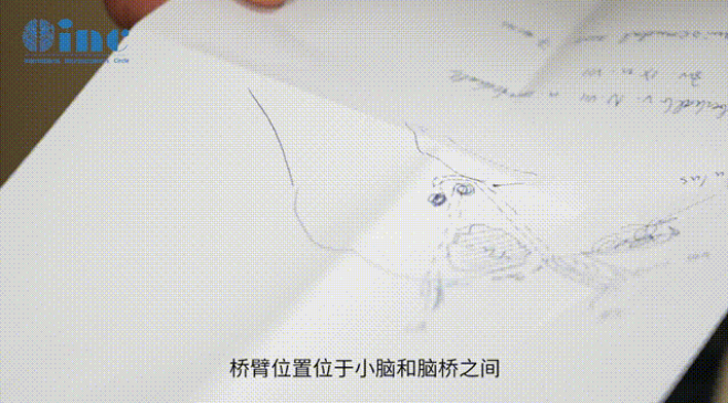 腦干橋臂膠質(zhì)瘤圖片