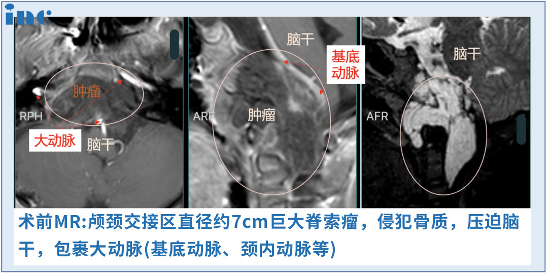 INC法國(guó)福洛里希教授真實(shí)案例