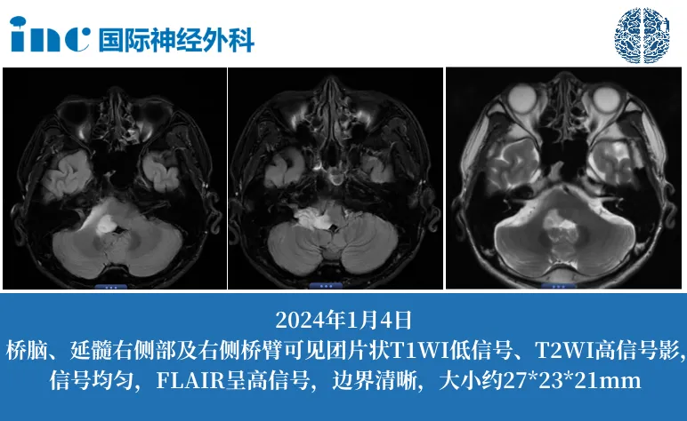膠質(zhì)瘤治療案例