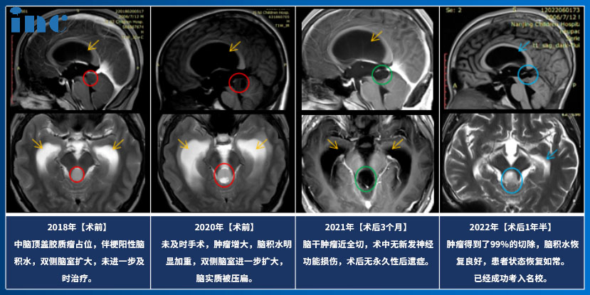 14歲男孩——腦干-中腦頂蓋毛細(xì)胞星形細(xì)胞瘤影像圖片
