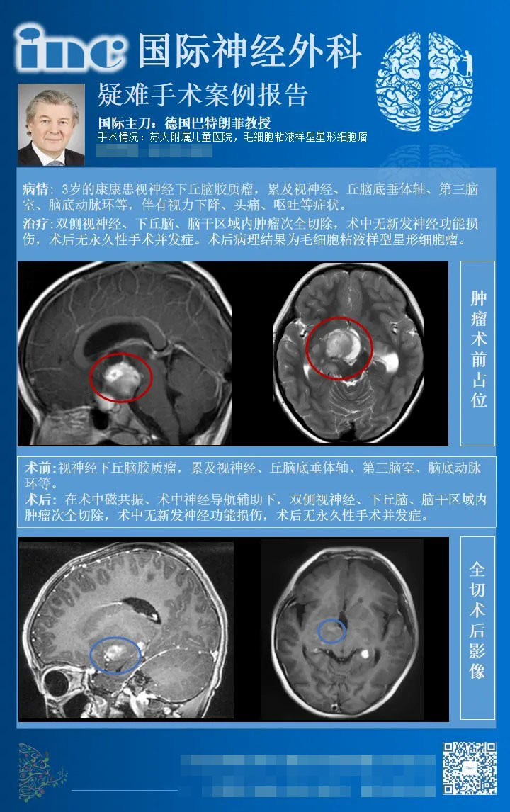 毛細(xì)胞粘液樣型星形細(xì)胞瘤手術(shù)案例圖片
