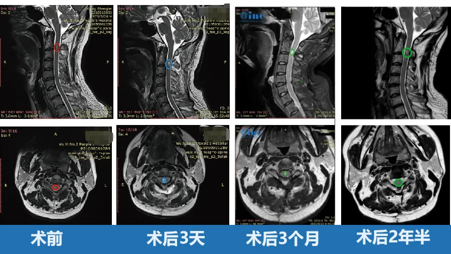 50歲男性——脊髓髓內(nèi)室管膜瘤圖片