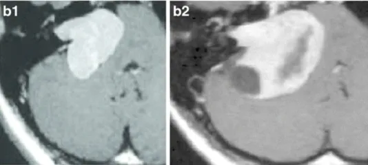 b-22歲女性。b-1增強后軸向MRI顯示右側(cè)中等大小的腫瘤(伽馬刀治療前)。b-2增強后軸向MRI顯示腫瘤進一步生長壓迫腦干和小腦(伽馬刀治療后3年)。腫瘤缺乏中央強化，可見小囊腫形成。