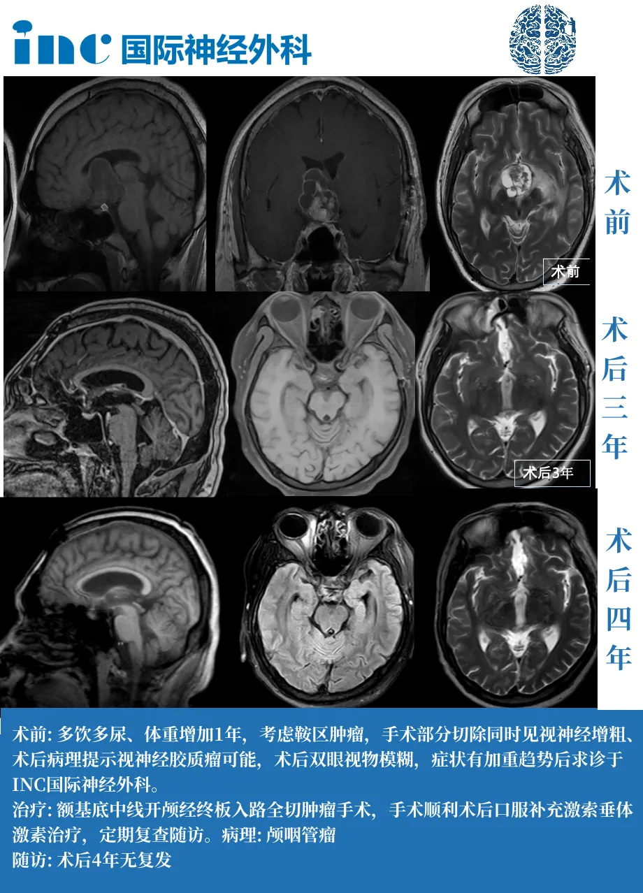 35歲男性——成功全切，術(shù)后4年沒(méi)有復(fù)發(fā)