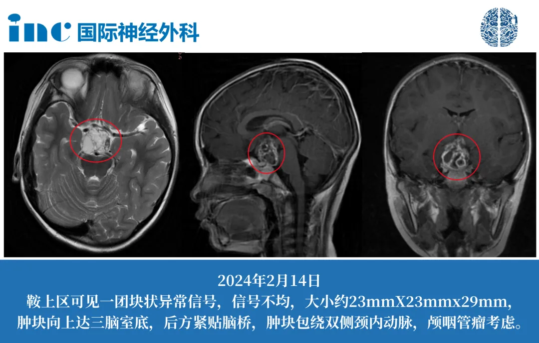 7歲低體重男孩——術(shù)后即刻清醒、垂體柄及功能保留