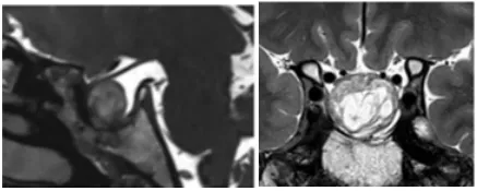 福教授術(shù)后一年MRI