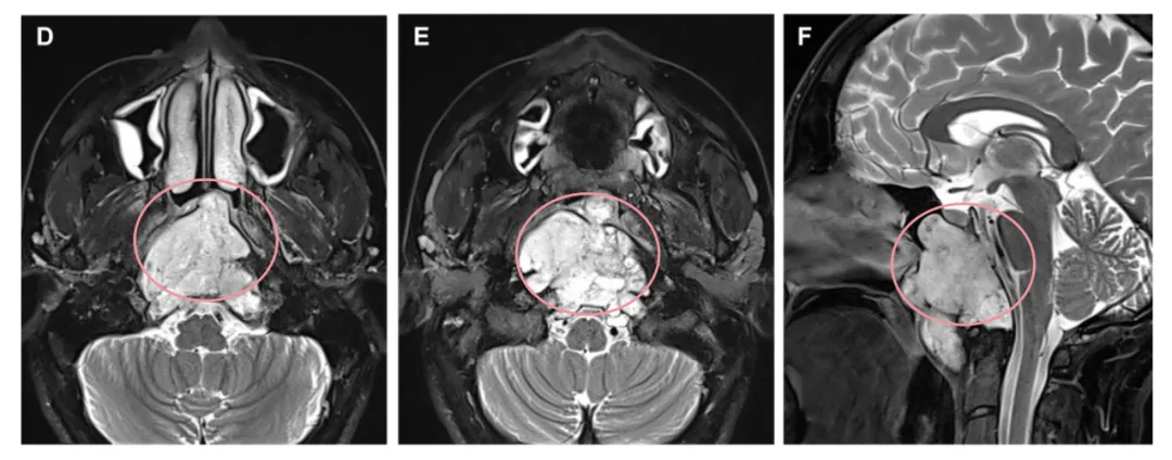 D、E術前軸向和F矢狀t2加權MRI