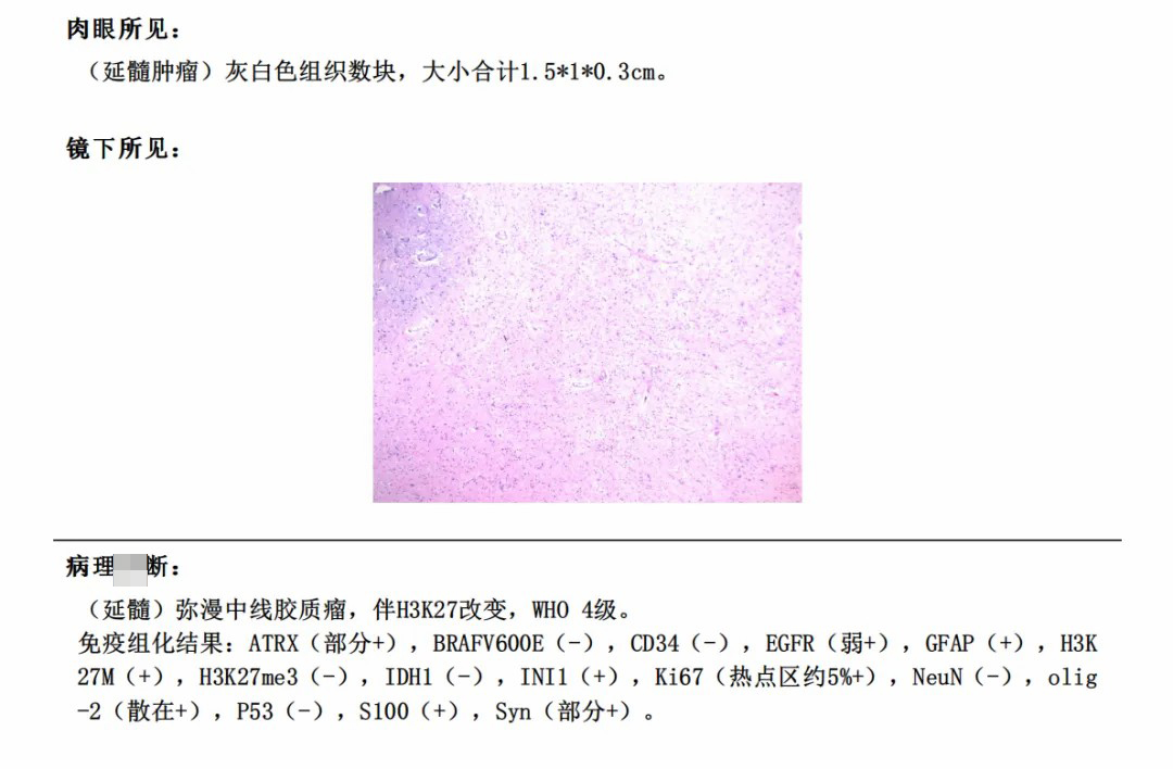 49歲男性-低級(jí)別膠質(zhì)瘤術(shù)后竟是四級(jí)