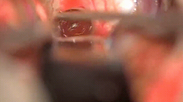 將腫瘤從腦室壁分離下來