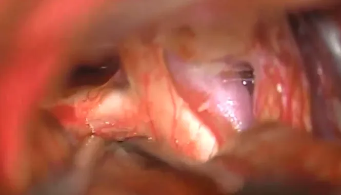 使用cusa進行腫瘤大部分減容