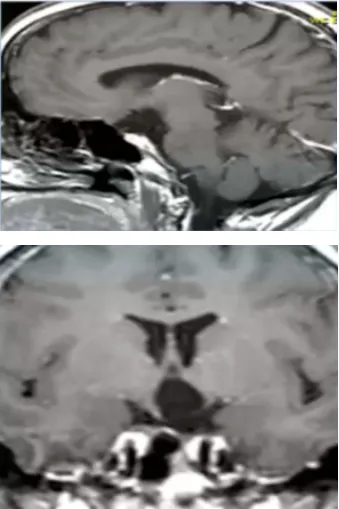 術(shù)后MRI，顯示解剖性全切除