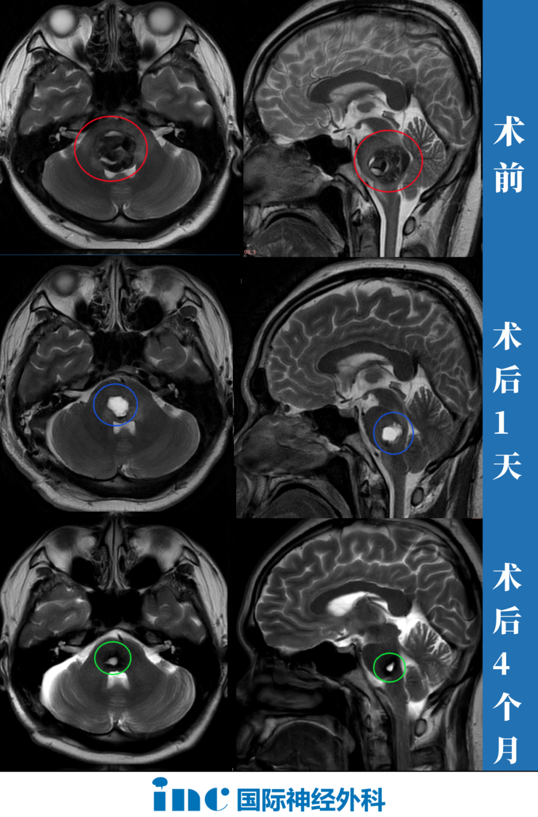 腦干海綿狀血管瘤患者術(shù)前術(shù)后影像對(duì)比圖片