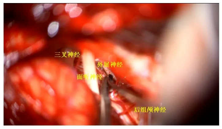 三叉神經(jīng)、面聽(tīng)神經(jīng)、外展神經(jīng)、后組神經(jīng)保護(hù)完好