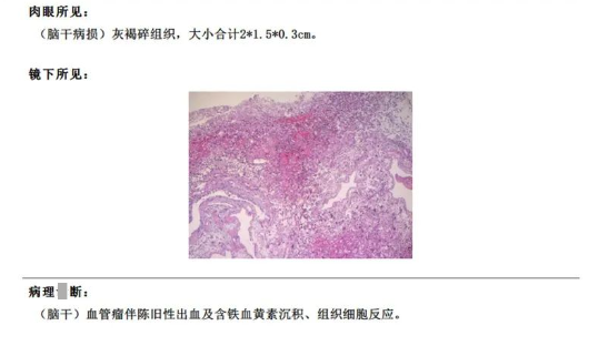 術(shù)后患者M(jìn)RI顯示面丘結(jié)構(gòu)恢復(fù)