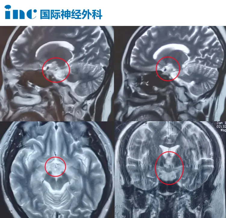 下丘腦病變?yōu)楹位顧z無法確診？