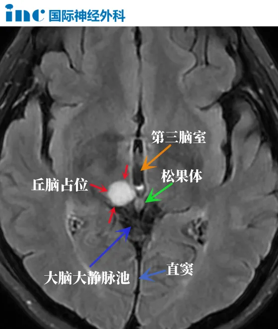 丘<a href='/naoliu/' target='_blank'><u>腦腫瘤</u></a>