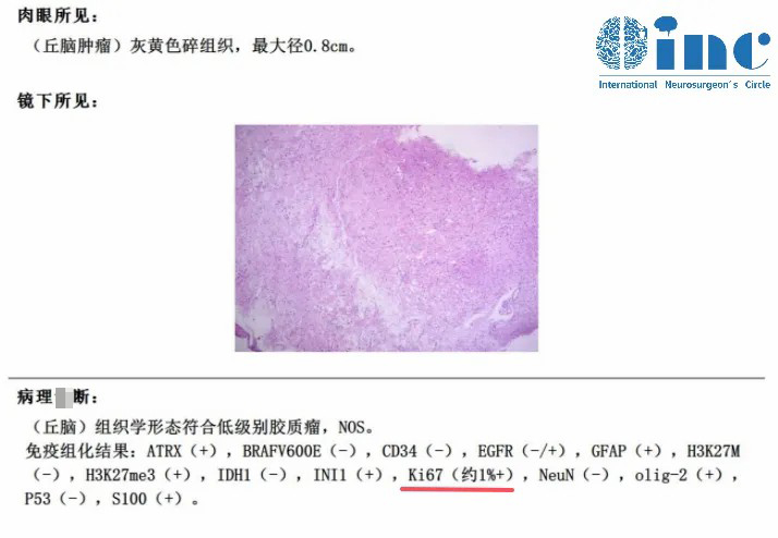 病理結(jié)果出來了，低級別膠質(zhì)瘤！Ki67約1%