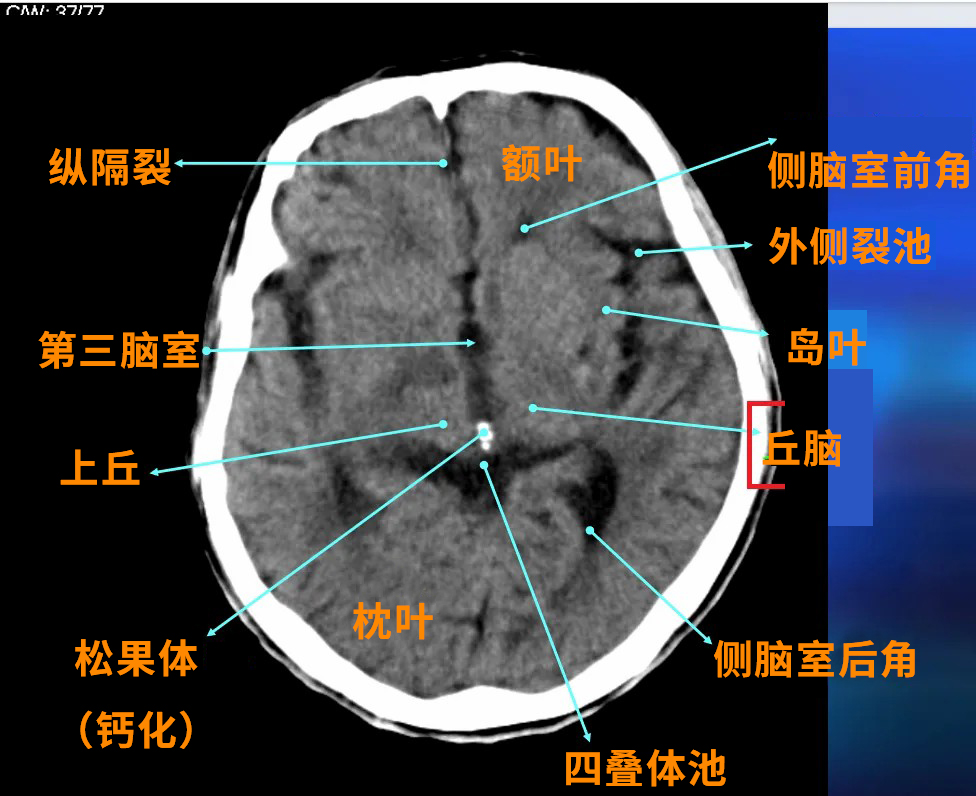 丘腦附近重要的鄰居有松果體、下丘腦、中腦。