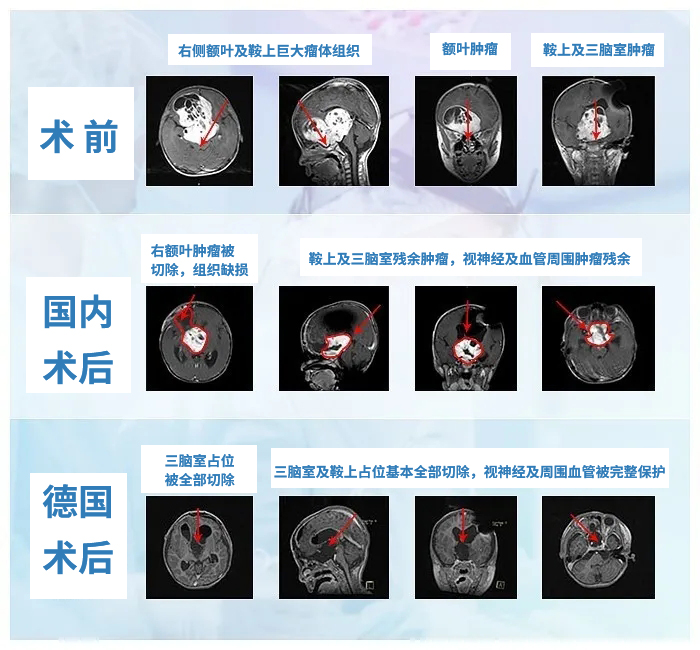5歲視神經(jīng)膠質(zhì)瘤患兒