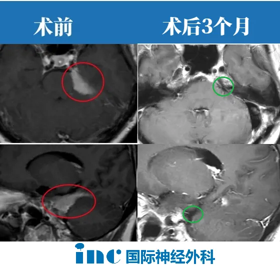 復(fù)雜型天幕腦膜瘤